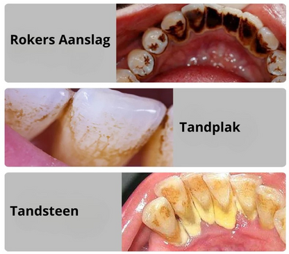SteenVrij™ - Zeg vaarwel tegen tandsteen, hallo tegen stralen